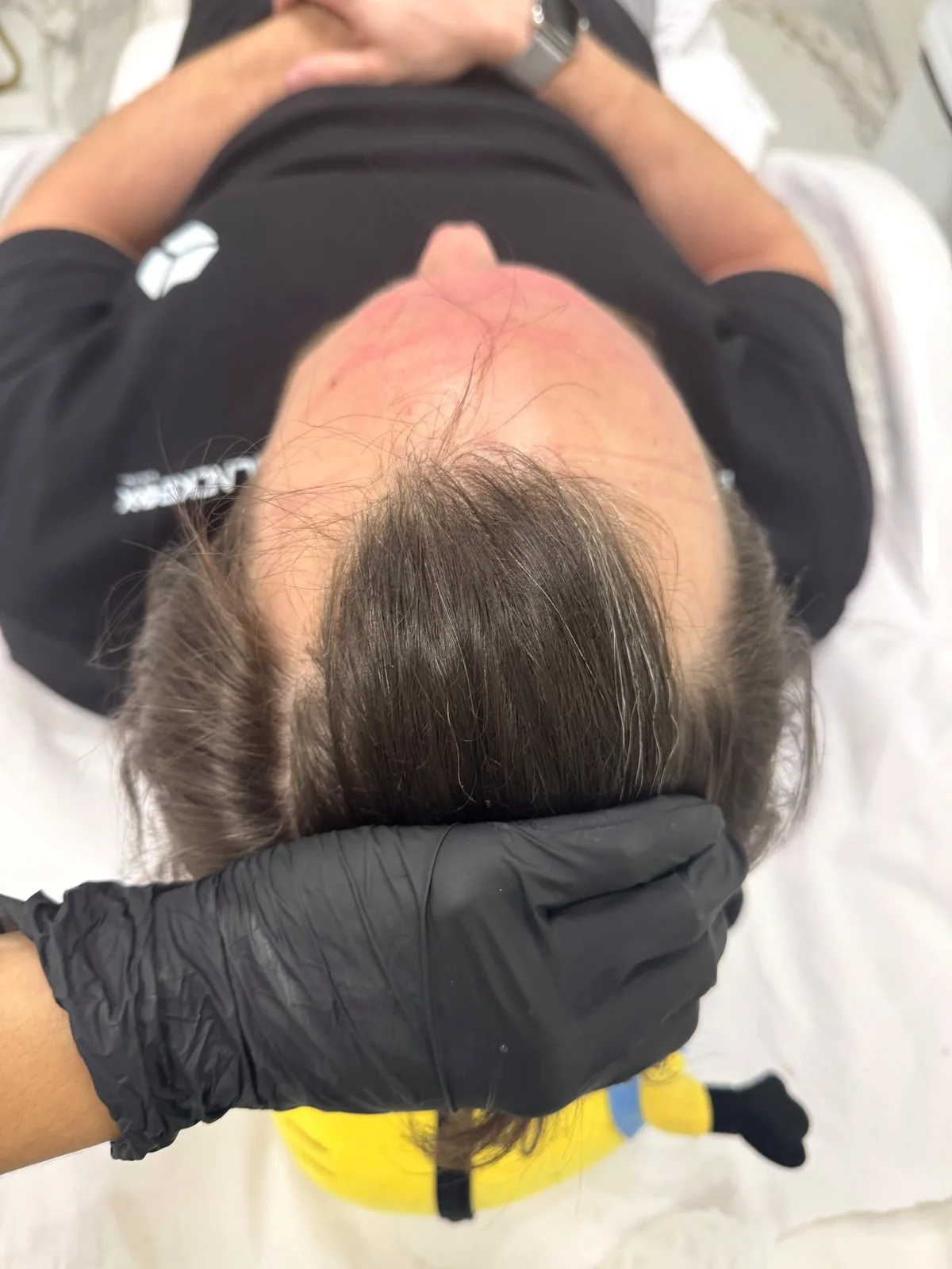 Intradermoterapia capilar masculina — avaliação do couro cabeludo na DC Estética Avançada, Dra. Daiana Coelho